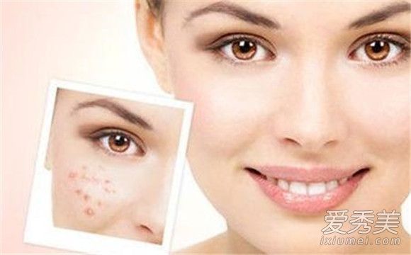 夏天长痘痘怎么办 夏天长痘痘的原因