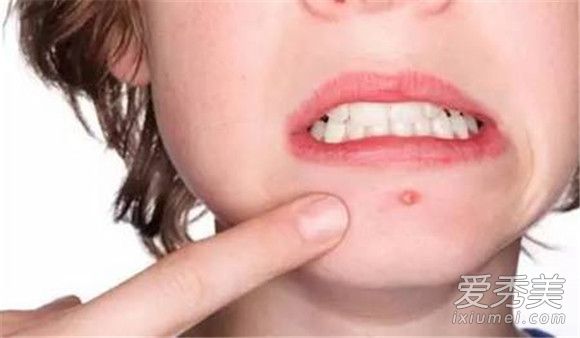 夏天长痘痘怎么办 夏天长痘痘的原因