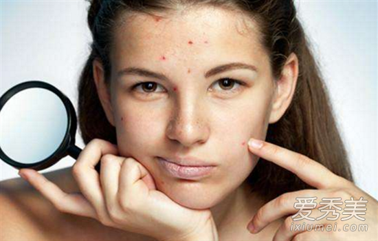 激光可以去痘印么 激光可以祛疤痕吗