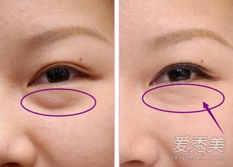 橄榄油可以去眼袋吗 蜂蜜和橄榄油能去眼袋吗
