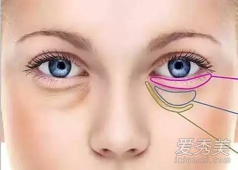 橄榄油可以去眼袋吗 蜂蜜和橄榄油能去眼袋吗