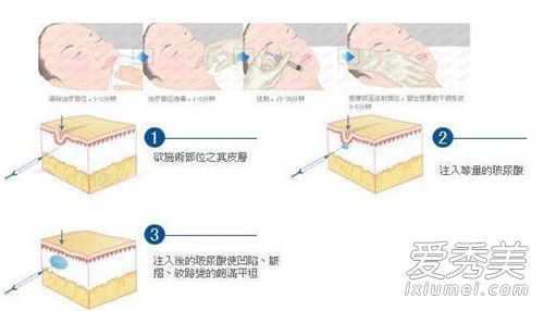 打完玻尿酸可以冰敷吗 打完玻尿酸可以敷面膜吗